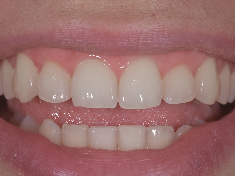 Rezultati profesionalnog izbjeljivanja zubi lampom u stomatološkoj ordinaciji Studio Dental Frntić Zagreb