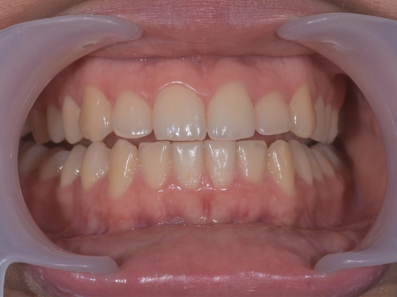 Stanje prije profesionalnog izbjeljivanja zubi lampom u zagrebačkoj stomatološkoj ordinaciji Studio Dental Frntić.