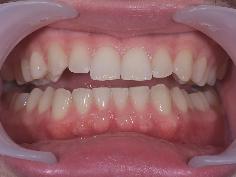 Rezultati izbjeljivanja zubi hidrogen peroksidom u stomatološkoj ordinaciji u Zagrebu.