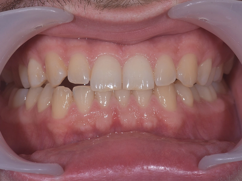 Stanje prije profesionalnog izbjeljivanja zubi hidrogen peroksidom u stomatološkoj ordinaciji u Zagrebu.
